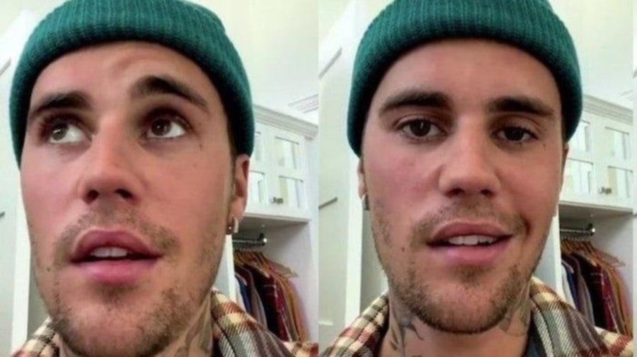 ‘As you can see, this eye is not blinking. I can't smile on the side of my face. This nostril will not move. So there's full paralysis in the side of my face,’ Justin Bieber said on June 11.
