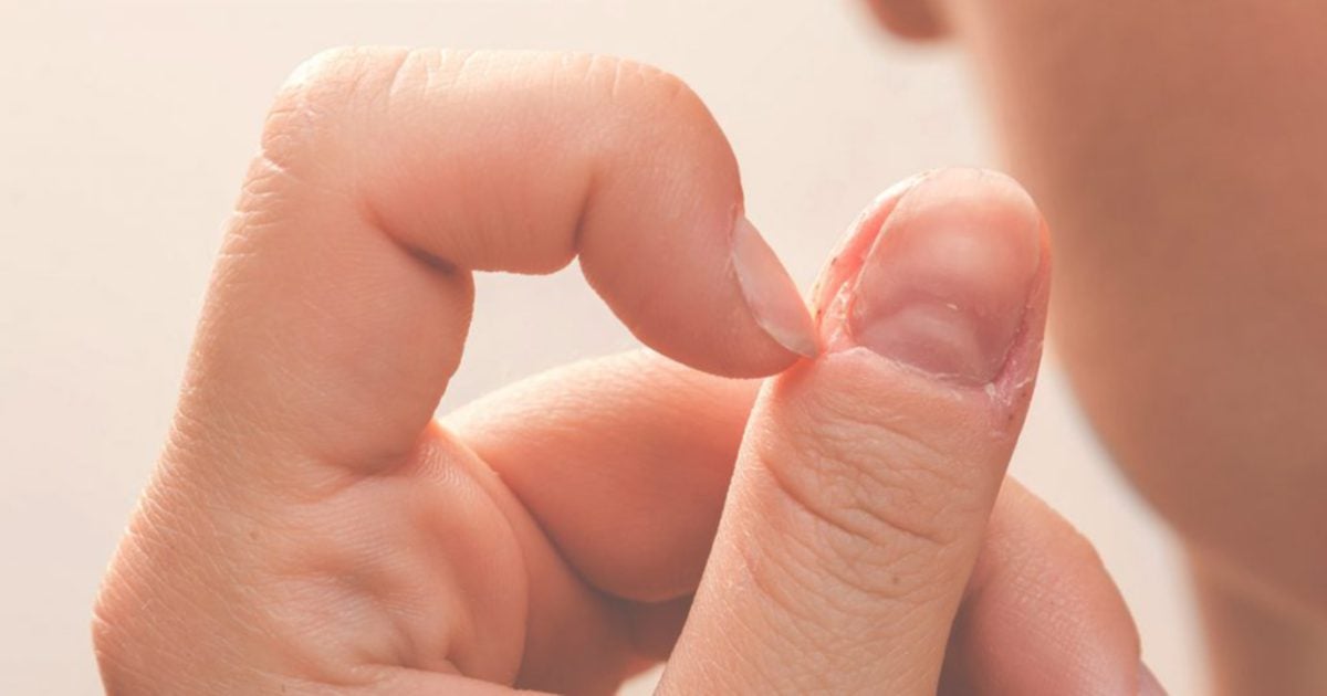 When nails bite back: Woman develops cancer from compulsive nail-biting;  thumb amputated