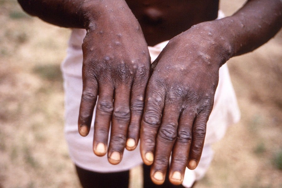An image created during an investigation into an outbreak of monkeypox, which took place in the Democratic Republic of the Congo (DRC), 1996 to 1997, shows the hands of a patient with a rash due to monkeypox. - REUTERS PIC