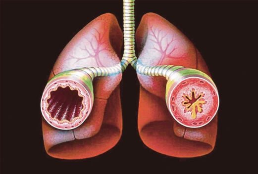 (File pix) Asthma is a chronic disease that causes the airways of the lungs to swell and narrow, which is known as inflammation and bronchoconstriction.