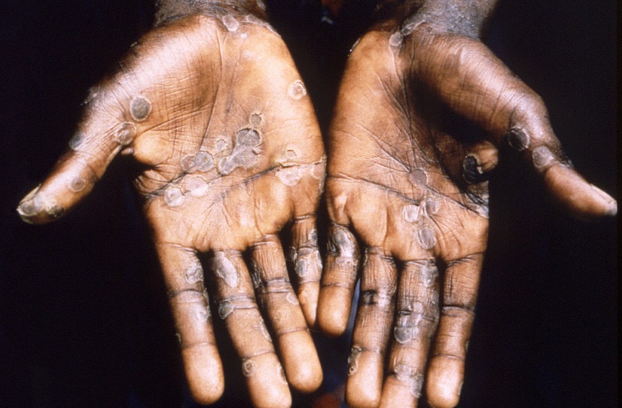 Britain is seeing daily infections of the rare monkeypox virus that are unconnected to any travel to West Africa, where the disease is endemic, a health official said on Sunday. - Reuters file pic