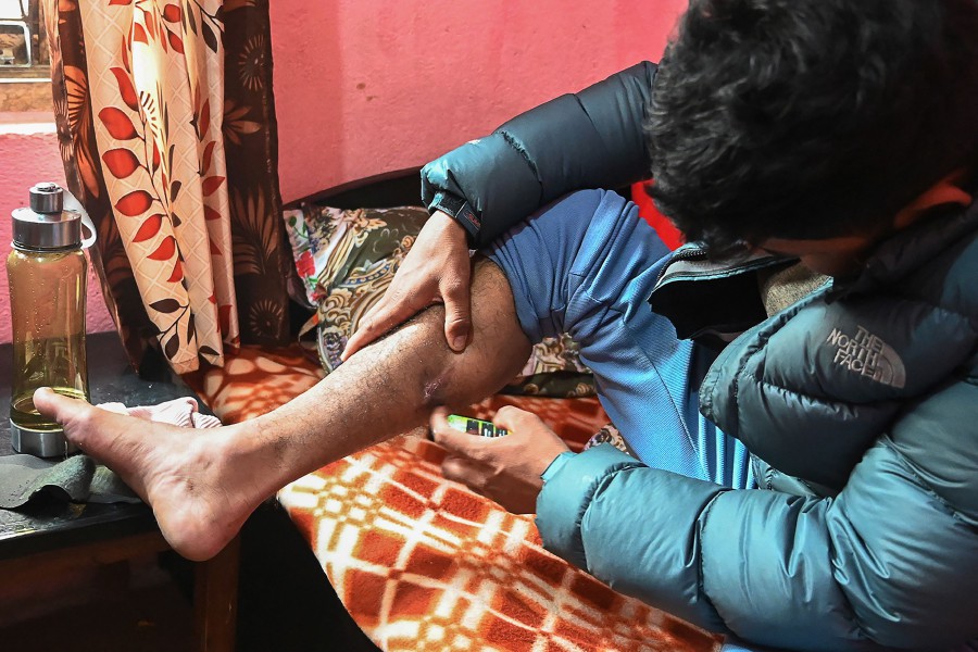 Surya Sharma, who joined the Russian army as a mercenary to fight in the invasion of Ukraine and asked to use a pseudonym for legal reasons, shows a combat injury during an interview with AFP at his rented residence in Kathmandu on Feb 6, 2024.