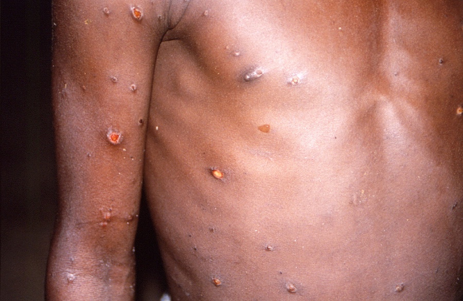 An image created during an investigation into an outbreak of monkeypox, which took place in the Democratic Republic of the Congo, 1996 to 1997, shows the arms and torso of a patient with skin lesions due to monkeypox. - Reuters Pic