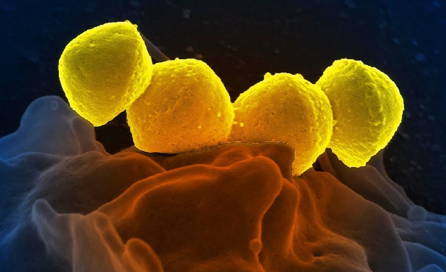 STSS, also known as severe invasive streptococcal infection, is a sudden-onset disease, caused by Group A Streptococcus. -- Filepic