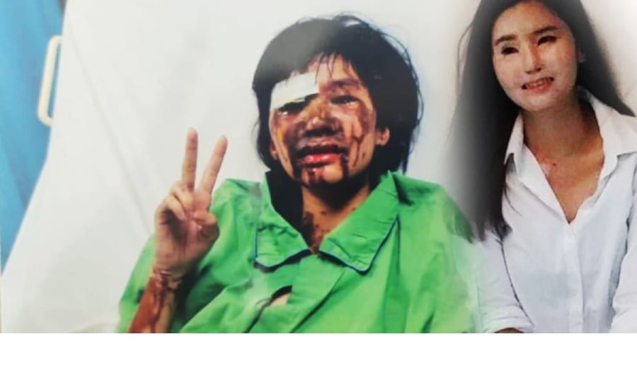 The 2009 acid attack not only disfigured 32-year-old flower seller Tan Hooi Ling's face but now threatens her vision completely. — FILE PIC