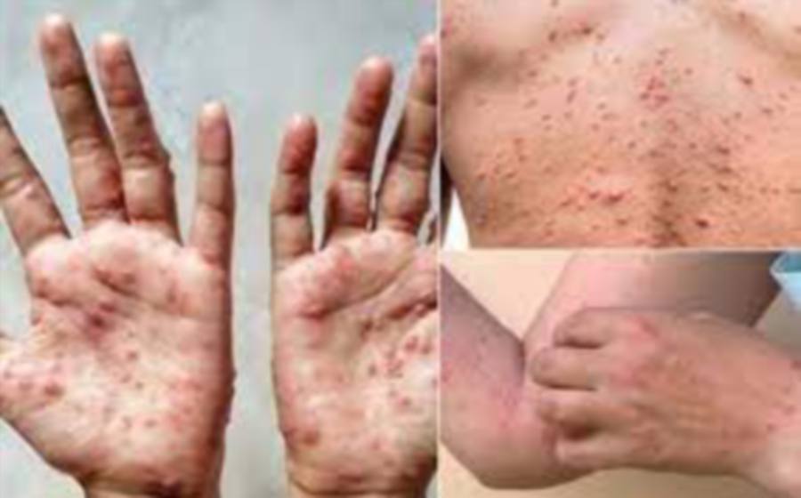Five cases of monkeypox infection (mpox) were reported between Oct 31 and Nov 29, bringing the cumulative number of cases to nine, the Health Ministry reported. - NSTP file pic