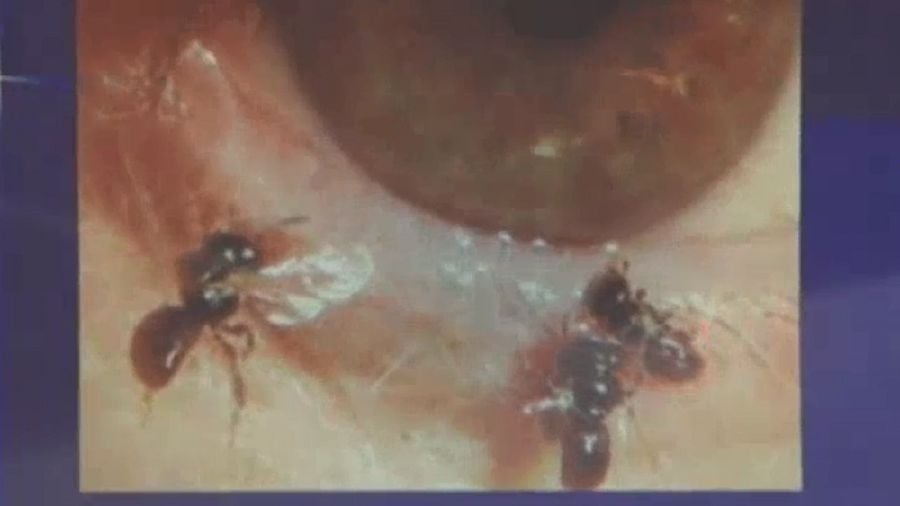 This videograb sourced from a video footage shows the sweat bees living under the woman’s eyelid. Pix source: abc.net.au