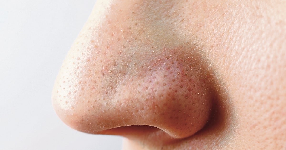 skin-cancer-on-the-nose-stock-image-c051-1232-science-photo-library