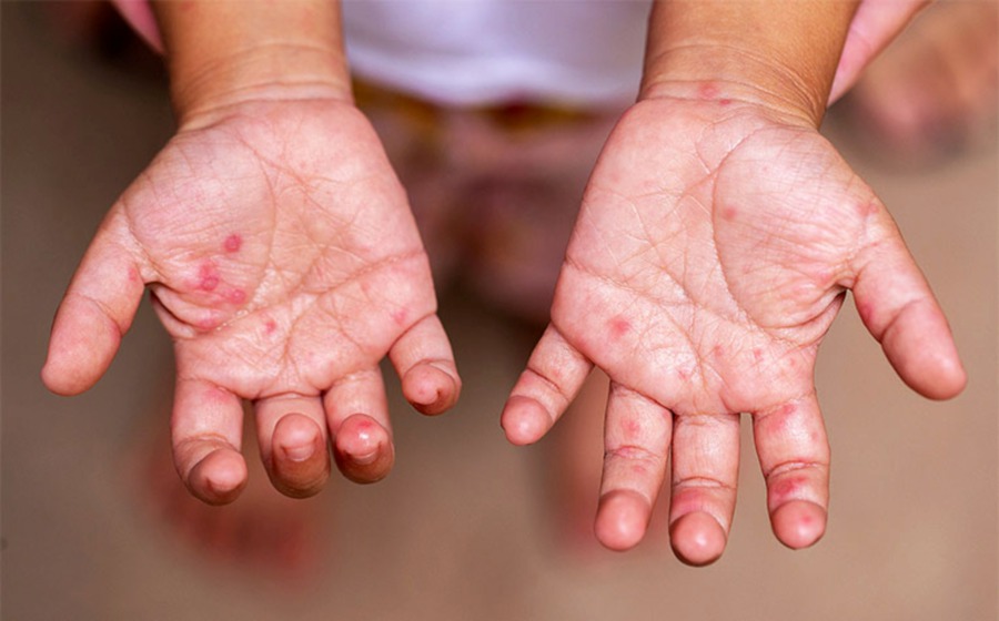 how-long-are-you-contagious-with-hand-foot-and-mouth-disease-goodrx