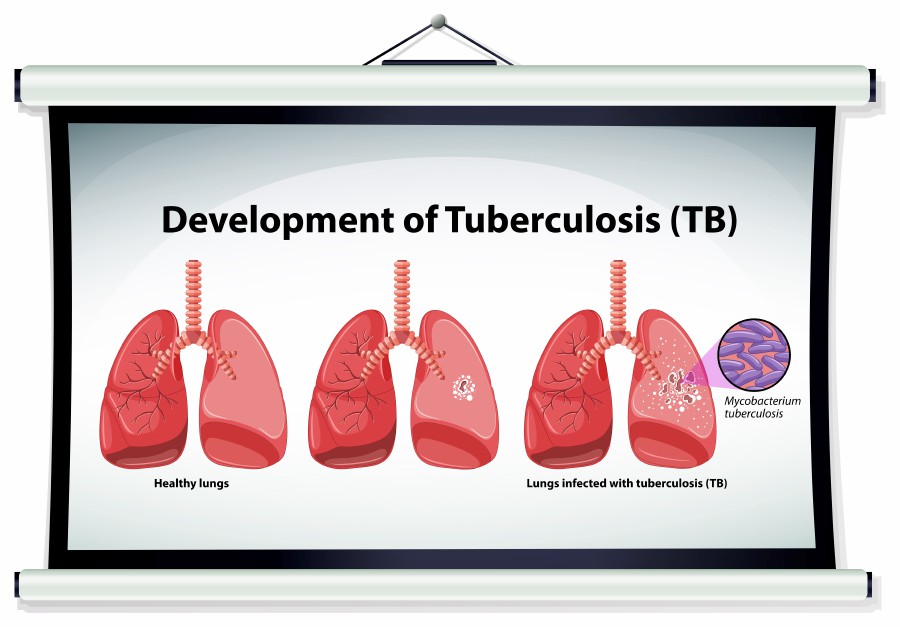 Chart showing development of Tuberculosis illustration - Courtesy pic