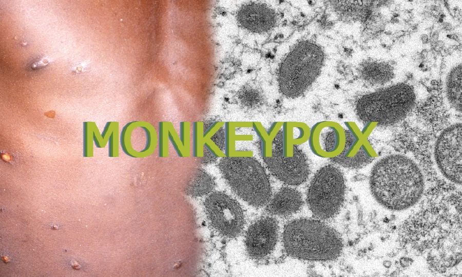Scientists do not expect the monkeypox outbreak to evolve into a pandemic like Covid-19, given the virus does not spread as easily as SARS-COV-2. - - NSTP file pic