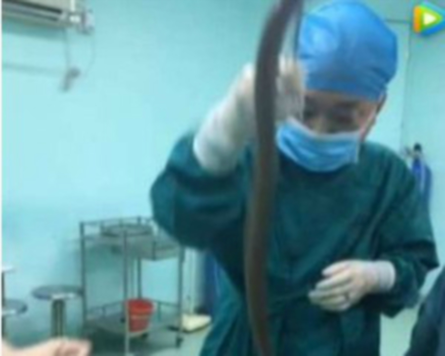 Chinese Man Inserts Live Eel Up Rectum To Cure Constipation, Almost ...