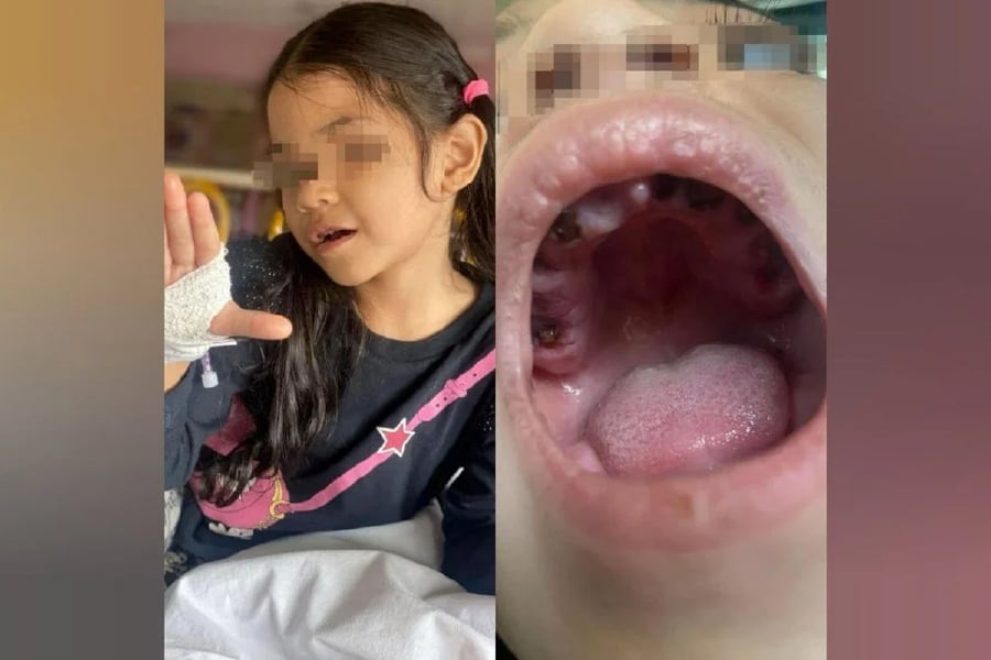A mother’s distress over her daughter named Chempaka Aulia needing 20 teeth extracted due to toothache has stirred debate on milk additives. - Pic courtesy from TikTok @Tomyamfloat
